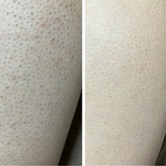 レディース腕脱毛1回¥4,500💪✨