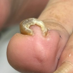 巻爪矯正様子見ましょう❗️