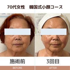 小顔モニター募集！３回￥15675♡