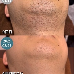 【小岩~市川で”脱毛”お探しの男性の方】