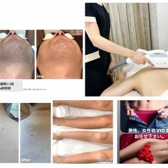 脱毛　光フェイシャル　バストアップの画像