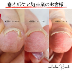 巻き爪ケア卒業👣