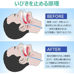 😴夏前早割セール【新品未使用】いびき防止 鼻用クリップ 8個セット 水洗いOK 軽量 専用ケース付 睡眠サポート 呼吸改善 痛くない 繰り返し使用可能 衛生的 旅行 携帯便利 検索ワード：いびき防止 鼻用クリップ 8個セット 水洗い可能 軽量 専用ケース 睡眠サポート 呼吸改善 痛くない 繰り返し使用 旅行 携帯便利の画像