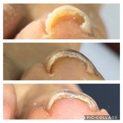 2回の施術でしばらくおやすみします❗️巻爪矯正 − 神奈川県