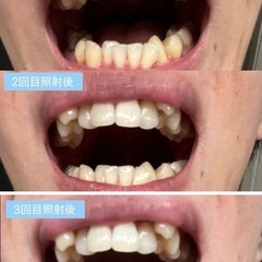 福岡市南区大橋/セルフホワイトニングで美しく