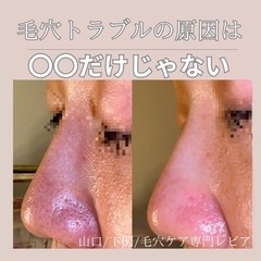 毛穴黒ずみ除去　下関