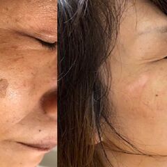 業界最高峰脱毛器 製造直販 新品460万円→180万円【2本タイプ：SHR＋IPL&Elight】トリプル脱毛＋フォトフラクショナル エステ業務用脱毛機の画像