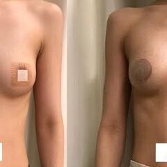 業界最高峰脱毛器 製造直販 新品460万円→180万円【2本タイプ：SHR＋IPL&Elight】トリプル脱毛＋フォトフラクショナル エステ業務用脱毛機の画像