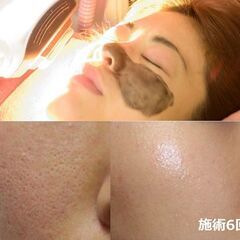業界最高峰脱毛器 製造直販 新品460万円→180万円【2本タイプ：SHR＋IPL&Elight】トリプル脱毛＋フォトフラクショナル エステ業務用脱毛機の画像