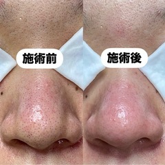 【残り5名】毛穴エステのモデル大募集【無料】