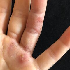 かゆ～い手疹は、さようなら出来る!の画像