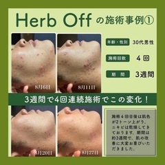 本気の肌革命🌼漢方ハーブピーリングの力をお試しください