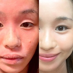 【5/14〜16限定無料モニター募集】アトピー肌から普通肌に生ま...