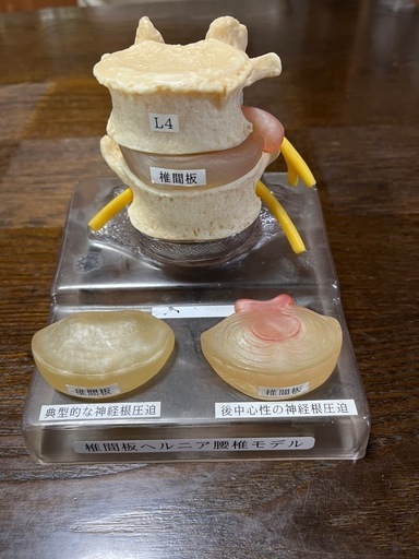椎間板ヘルニア腰椎モデル。