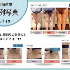 碧南市/脂肪冷却/痩身/ダイエット/切らない脂肪吸引★地域最安値の4カップ￥10,400👀✨️ − 愛知県