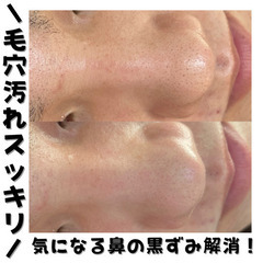 【先着モニター募集】ハーブピーリング3回 ¥15,000