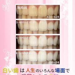 ホワイトニング👄