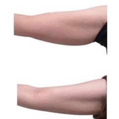 ✨世界最先端大注目の無料体験　脂肪冷却＋筋肉増量✨ - 地元のお店