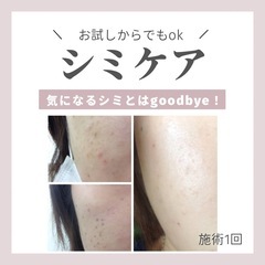 シミケアお試し✨️