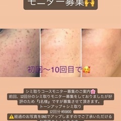 12回分 シミ取りモニター募集