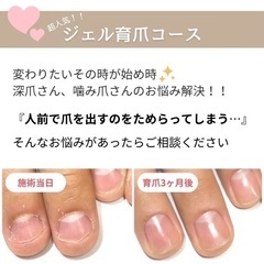 【深爪.噛み爪さん専用】育爪のご案内