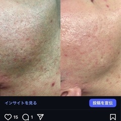 メンズ脱毛　やってみませんか？（北谷町） - 中頭郡
