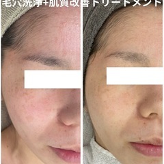 【6月 ジモティー限定】 ＼ お肌改善モデル募集 ／ − 沖縄県