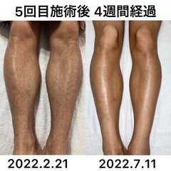 メンズ全身脱毛キャンペーンVIOお顔込み
