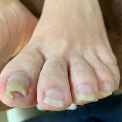 爪トラブルでお悩みの方　解消しませんか