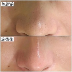 さくっと毛穴洗浄！