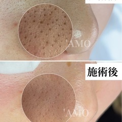 この夏毛穴悩み改善しませんか？