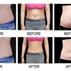 ★史上最高峰★脂肪冷却冷凍痩身機器「Dr.SLIM FROZEN MESO」エステ以上の効果、エステでは叶わないリバウンドなしの痩身機器の画像