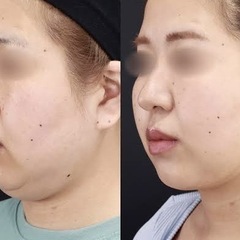 2025.09.韓国🇰🇷日本初上陸🇰🇷クリニック使用脂肪溶…