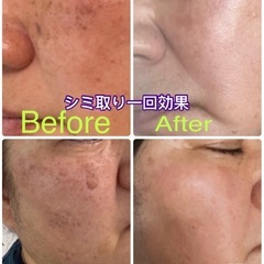 ❤️‍🔥一回のシミ取りで顔全体のシミ解決します❣️