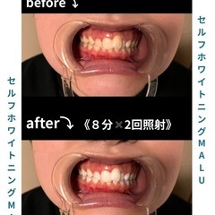 セルフホワイトニング　before after✨