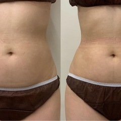 🉐¥5,000！痛みなしダブル痩身でお腹痩せ❣️