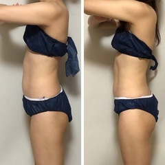🉐¥5,500！痛みなしダブル痩身でお腹痩せ❣️の画像