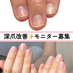  【深爪・貝爪改善】症例モニター募集✨手元のみ撮影・3ヶ月…
