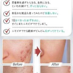 ①新品未開封！3点セット THEU 薬用 メンズ ニキビケア ローション 洗顔の画像