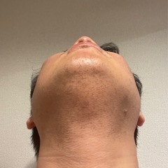 脱毛モニター様募集⭐️の画像