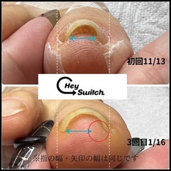痛くない！新！巻き爪ケア　モニター【泉佐野市】