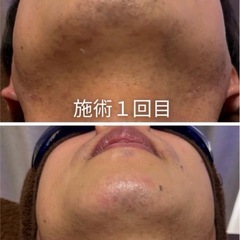 【新品未使用】業務用脱毛器GLEE/光フォト/光豊胸の画像