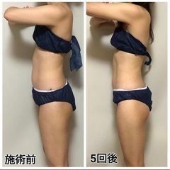 寝るだけ痩身+歯のホワイトニングセット❣️同時施術で¥5,000🥹✨の画像