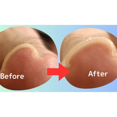 限定！お得★巻き爪ケア★器具の装置や痛みなく見た目が綺麗！