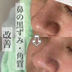 小鼻の黒ずみ、角質、産毛が気になってる方にオススメメニュー…
