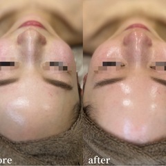 フェイシャルwax🉐¥5,500🥺✨その日でツルツル艶々です！！