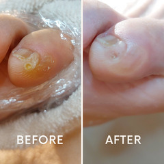 無料フットケアモデル　11月17日（月）魚の目ケア - 中央区