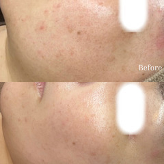 【剥離なしハーブピーリング】毛穴・ニキビ・赤み改善◎