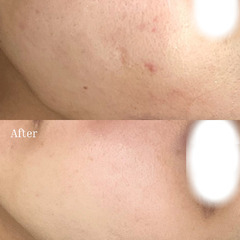 【剥離ありハーブ】7日後の肌変化◎ニキビ跡・毛穴改善に