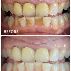 ホワイトニング施術🦷1名様限定！2年間通い放題😳※詳しくは本文をご覧くださいの画像